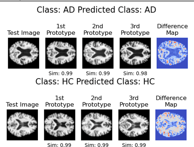 Figure 3 for Interpretable Alzheimer's Disease Classification Via a Contrastive Diffusion Autoencoder