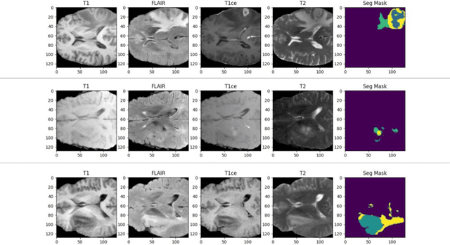 Figure 1 for Efficient Brain Tumor Segmentation Using a Dual-Decoder 3D U-Net with Attention Gates (DDUNet)