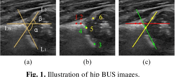 Figure 1 for Topological GCN for Improving Detection of Hip Landmarks from B-Mode Ultrasound Images