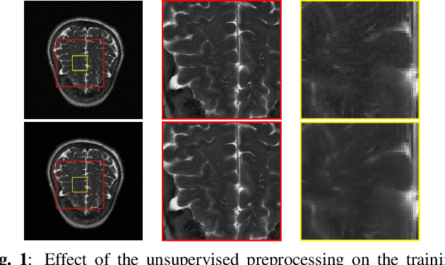 Figure 1 for Robust plug-and-play methods for highly accelerated non-Cartesian MRI reconstruction