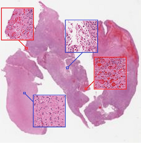 Figure 1 for Patch-based Convolutional Neural Network for Whole Slide Tissue Image Classification