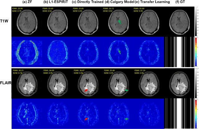 Figure 4 for Transfer Learning Enhanced Generative Adversarial Networks for Multi-Channel MRI Reconstruction