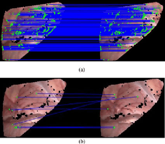 Figure 2 for Dynamic Reconstruction of Deformable Soft-tissue with Stereo Scope in Minimal Invasive Surgery