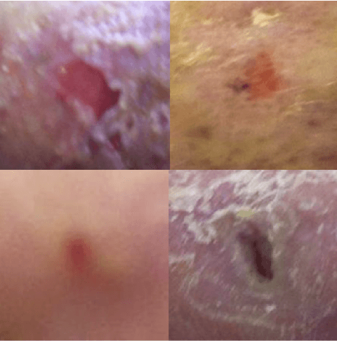 Figure 1 for Deep Subspace analysing for Semi-Supervised multi-label classification of Diabetic Foot Ulcer