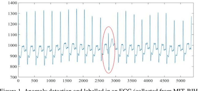 Figure 1 for A Modified Dynamic Time Warping Approach and Innovative Average Non-Self Match Distance Method for Anomaly Detection in ECG Recordings
