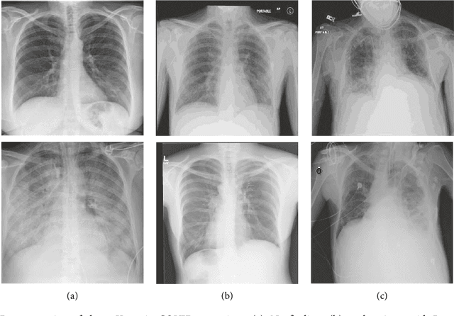 Figure 3 for A novel framework based on deep learning and ANOVA feature selection method for diagnosis of COVID-19 cases from chest X-ray Images