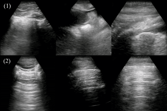 Figure 1 for COVID-Net US: A Tailored, Highly Efficient, Self-Attention Deep Convolutional Neural Network Design for Detection of COVID-19 Patient Cases from Point-of-care Ultrasound Imaging