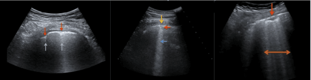 Figure 4 for COVID-Net US: A Tailored, Highly Efficient, Self-Attention Deep Convolutional Neural Network Design for Detection of COVID-19 Patient Cases from Point-of-care Ultrasound Imaging