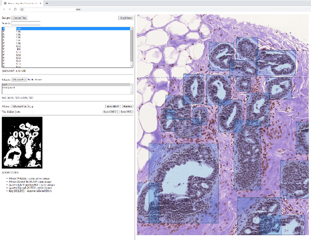 Figure 4 for Classifying Breast Histopathology Images with a Ductal Instance-Oriented Pipeline