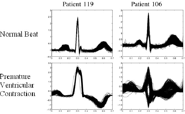 Figure 4 for Feature Extraction and Automated Classification of Heartbeats by Machine Learning