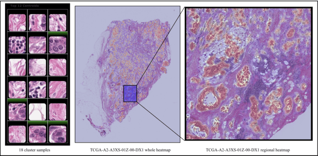 Figure 3 for Unsupervised Learning of Deep-Learned Features from Breast Cancer Images