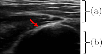 Figure 1 for Delineating Bone Surfaces in B-Mode Images Constrained by Physics of Ultrasound Propagation