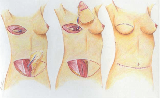 Figure 1 for Computer Aided Detection of Deep Inferior Epigastric Perforators in Computed Tomography Angiography scans