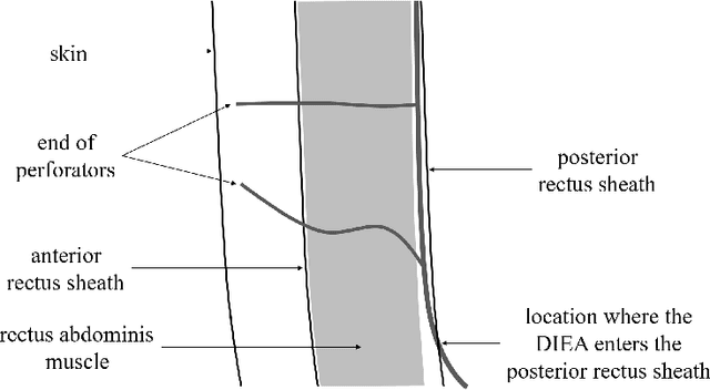 Figure 3 for Computer Aided Detection of Deep Inferior Epigastric Perforators in Computed Tomography Angiography scans