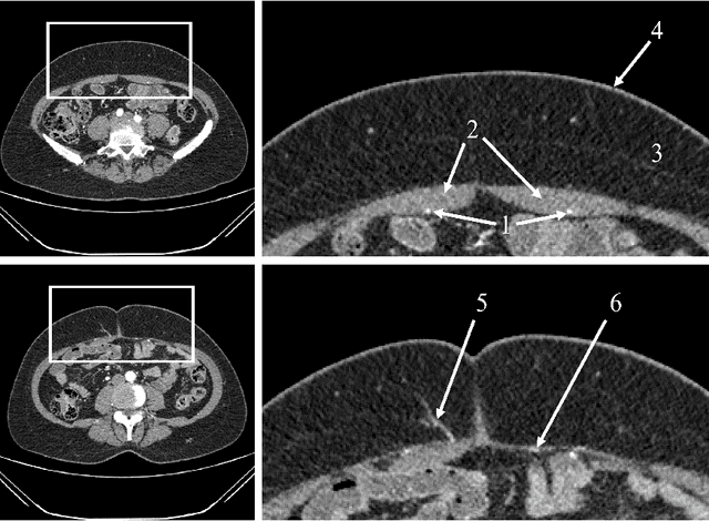 Figure 4 for Computer Aided Detection of Deep Inferior Epigastric Perforators in Computed Tomography Angiography scans