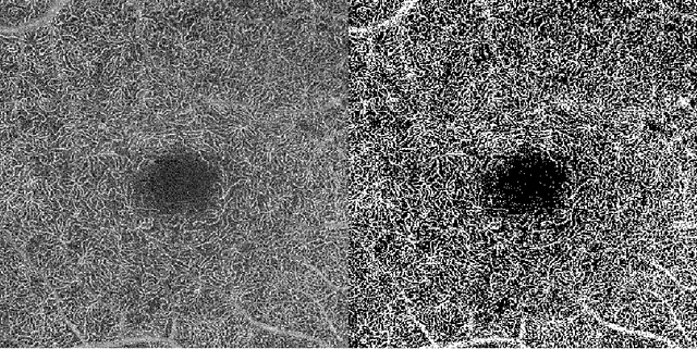 Figure 1 for Microvasculature Segmentation and Inter-capillary Area Quantification of the Deep Vascular Complex using Transfer Learning