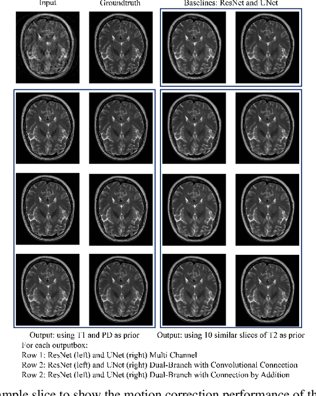 Figure 2 for Retrospective Motion Correction of MR Images using Prior-Assisted Deep Learning