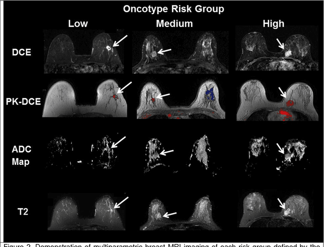 Figure 4 for Advanced machine learning informatics modeling using clinical and radiological imaging metrics for characterizing breast tumor characteristics with the OncotypeDX gene array
