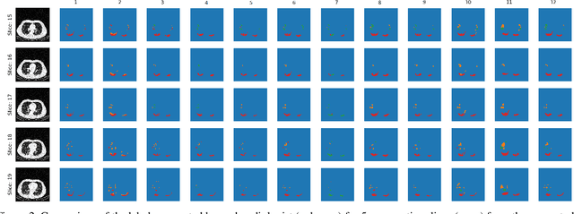 Figure 4 for Segmentation of Pulmonary Opacification in Chest CT Scans of COVID-19 Patients