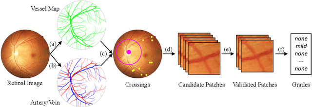 Figure 3 for Grading the Severity of Arteriolosclerosis from Retinal Arterio-venous Crossing Patterns