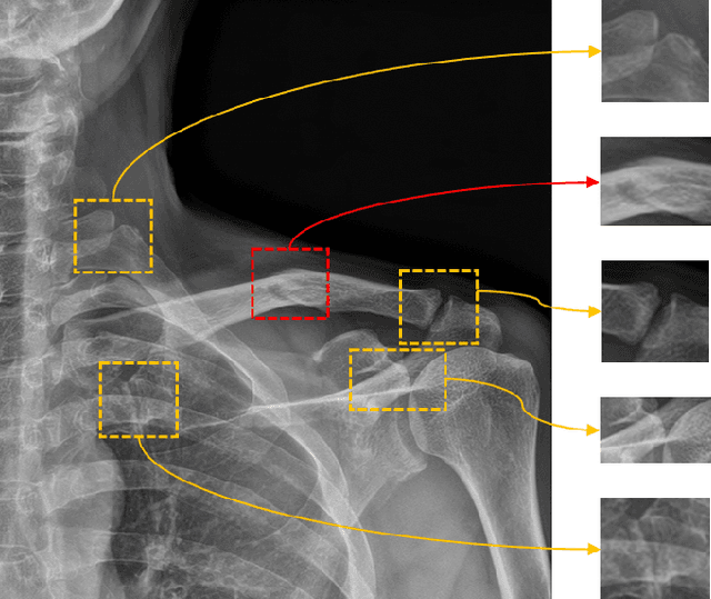 Figure 1 for Look at here : Utilizing supervision to attend subtle key regions