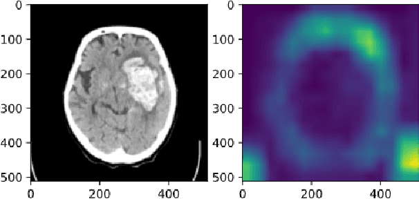 Figure 2 for Classification of Hematoma: Joint Learning of Semantic Segmentation and Classification