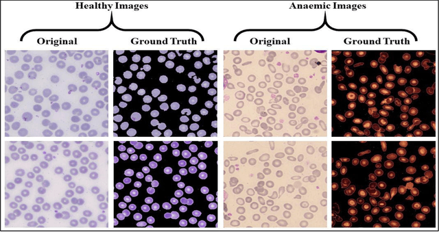 Figure 3 for Semantic Segmentation of Anaemic RBCs Using Multilevel Deep Convolutional Encoder-Decoder Network