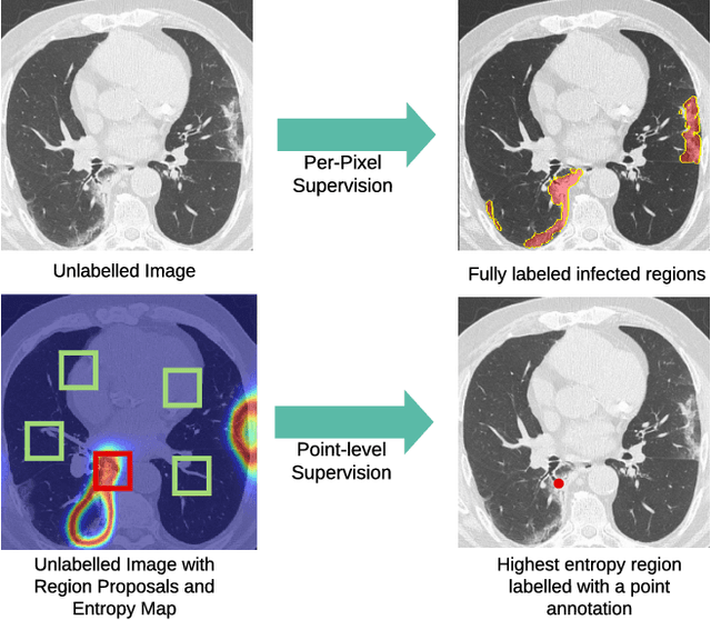 Figure 1 for A Weakly Supervised Region-Based Active Learning Method for COVID-19 Segmentation in CT Images