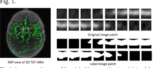 Figure 1 for Y-net: 3D intracranial artery segmentation using a convolutional autoencoder