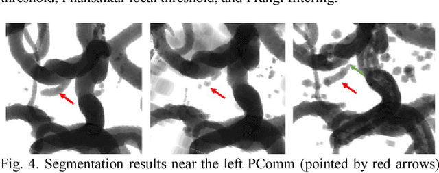 Figure 4 for Y-net: 3D intracranial artery segmentation using a convolutional autoencoder