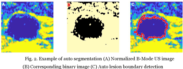 Figure 3 for Weighted Contourlet Parametric (WCP) Feature Based Breast Tumor Classification from B-Mode Ultrasound Image