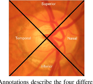 Figure 2 for An adaptive thresholding approach for automatic optic disk segmentation