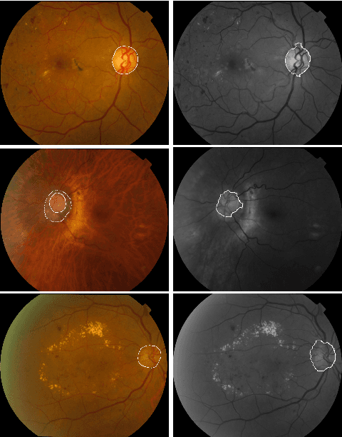Figure 4 for An adaptive thresholding approach for automatic optic disk segmentation