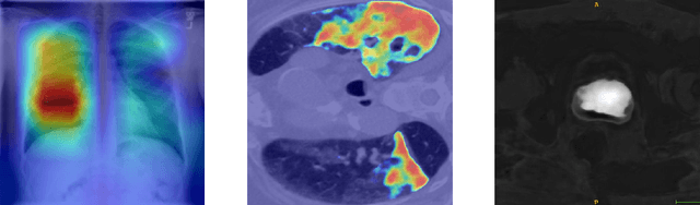 Figure 1 for M3d-CAM: A PyTorch library to generate 3D data attention maps for medical deep learning