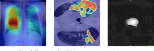 Figure 3 for M3d-CAM: A PyTorch library to generate 3D data attention maps for medical deep learning