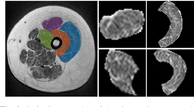 Figure 3 for Severity classification in cases of Collagen VI-related myopathy with Convolutional Neural Networks and handcrafted texture features
