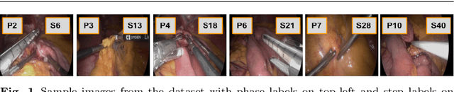 Figure 1 for Multi-Task Temporal Convolutional Networks for Joint Recognition of Surgical Phases and Steps in Gastric Bypass Procedures