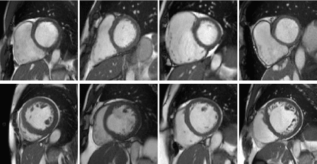 Figure 4 for Unsupervised shape and motion analysis of 3822 cardiac 4D MRIs of UK Biobank