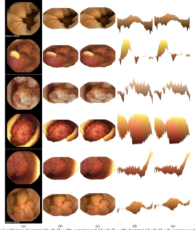 Figure 3 for Challenges of 3D Surface Reconstruction in Capsule Endoscopy