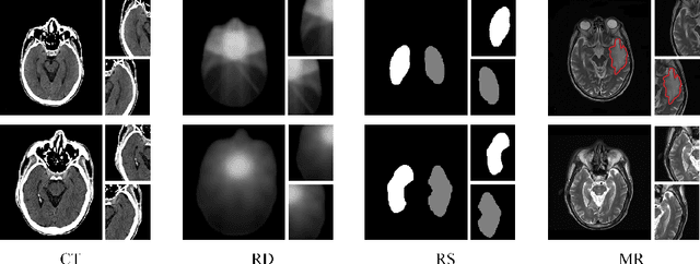 Figure 1 for Weighted Concordance Index Loss-based Multimodal Survival Modeling for Radiation Encephalopathy Assessment in Nasopharyngeal Carcinoma Radiotherapy