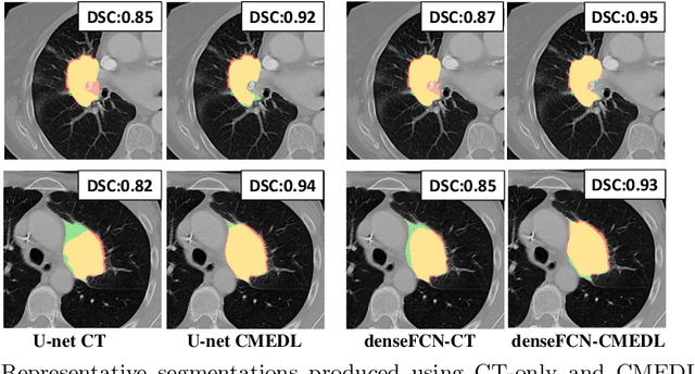 Figure 4 for Integrating cross-modality hallucinated MRI with CT to aid mediastinal lung tumor segmentation