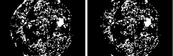 Figure 1 for Detection of Diabetic Anomalies in Retinal Images using Morphological Cascading Decision Tree