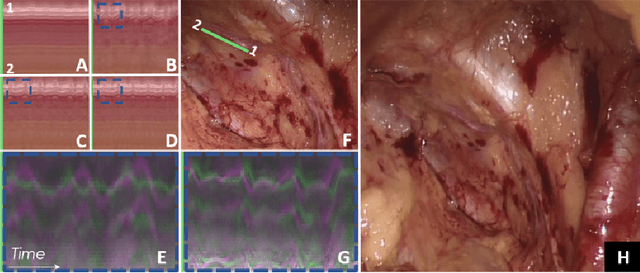 Figure 4 for Higher Order of Motion Magnification for Vessel Localisation in Surgical Video