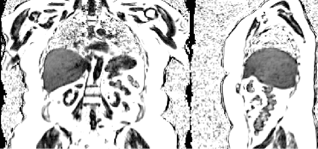 Figure 1 for Large-scale inference of liver fat with neural networks on UK Biobank body MRI