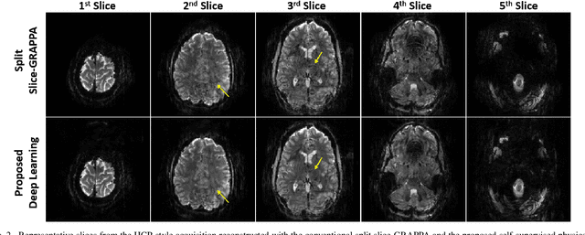 Figure 2 for Improved Simultaneous Multi-Slice Functional MRI Using Self-supervised Deep Learning