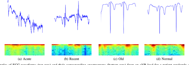 Figure 2 for DeepMI: Deep Multi-lead ECG Fusion for Identifying Myocardial Infarction and its Occurrence-time
