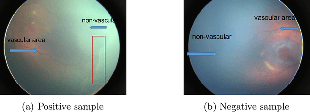 Figure 1 for Early Detection of Retinopathy of Prematurity in Retinal Fundus Images Via Convolutional Neural Networks