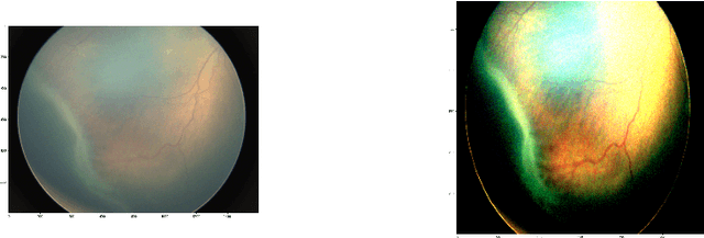 Figure 3 for Early Detection of Retinopathy of Prematurity in Retinal Fundus Images Via Convolutional Neural Networks