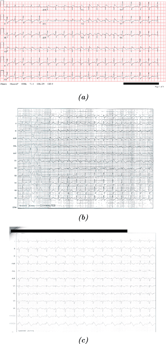 Figure 1 for Teaching a Machine to Diagnose a Heart Disease; Beginning from digitizing scanned ECGs to detecting the Brugada Syndrome