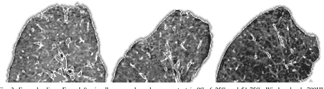 Figure 3 for Learning to quantify emphysema extent: What labels do we need?